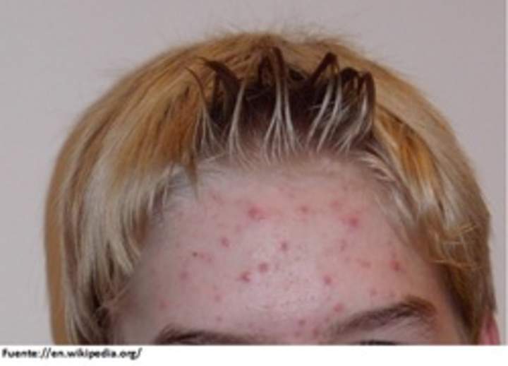 Imagen de acne