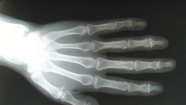 Radiografía de una mano