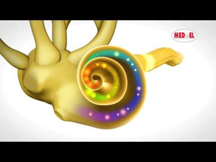 La pérdida de audición neurosensorial ocurre en la cóclea La pérdida de audición neurosensorial ocurre en la cóclea