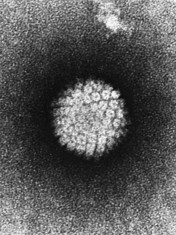 Un virus que causa cáncer Un virus que causa cáncer