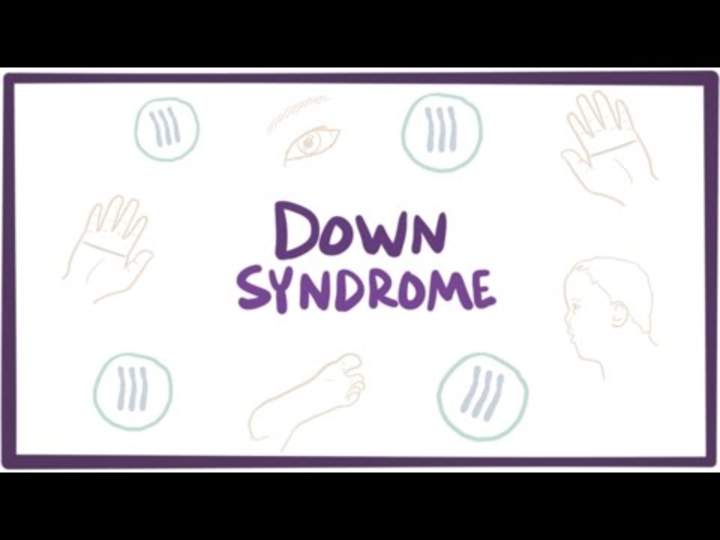 Síndrome de Down (trisomía 21): causas, síntomas, diagnóstico y patología Síndrome de Down (trisomía 21): causas, síntomas, diagnóstico y patología