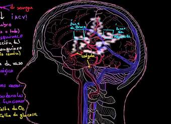 ¿Qué es el accidente cerebrovascular?